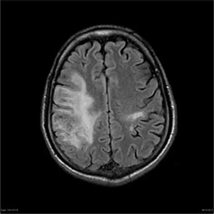 Understanding Acute Toxic Progressive Leukoencephalopathy: Symptoms, Causes, and Treatment